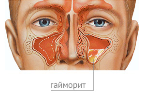 Лечение гайморита в Москве