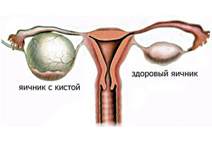Диагностика кисты яичника