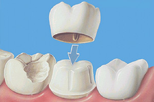 Восстановление разрушенного зуба: основные методы