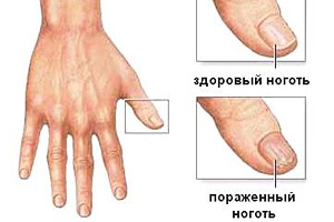Грибок ногтей и пальцев рук
