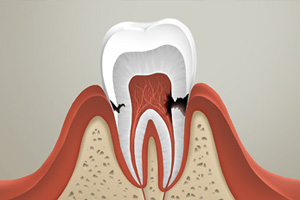 Лечение кариеса шейки зуба