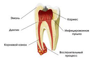 Лечение воспаления зубного канала