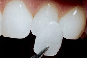 Установка виниров на зубы