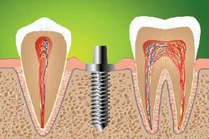 Удаление зуба и установка импланта