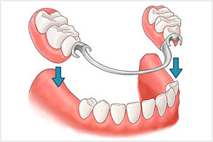 Полное съемное протезирование зубов