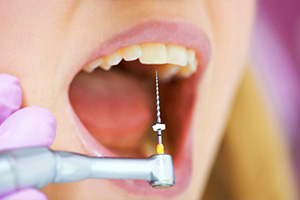 Пломбирование корневых каналов зубов