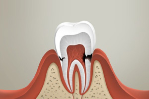 Лечение пришеечного кариеса зубов