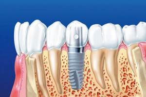 Восстановление удаленного зуба