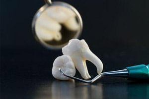 Удаление сломанного зуба