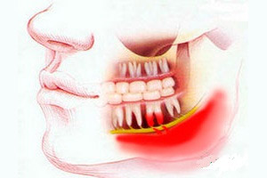 Лечение флегмоны полости рта