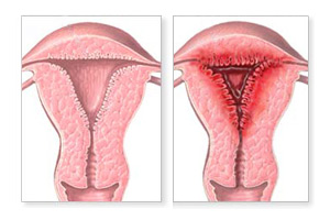 Диагностика эндометриоза матки