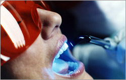 Отбеливание зубов лазером: красивая улыбка надолго