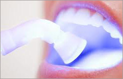 Отбеливание зубов лазером: красивая улыбка надолго